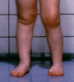 Child's swollen knee due to Juvenile Idiopathic Arthritis
