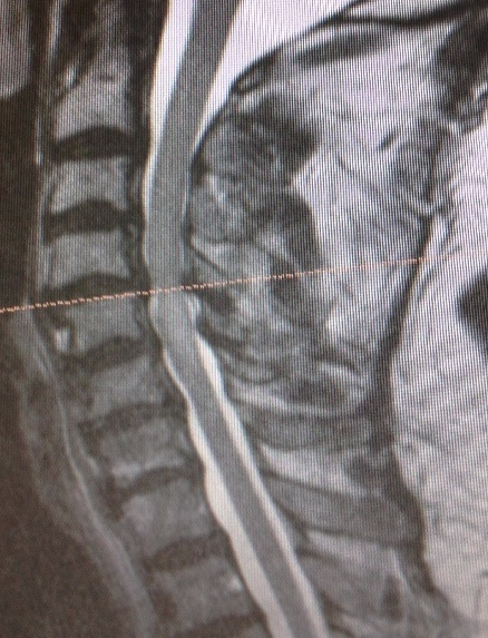 Cervical Spine MRI Treatment